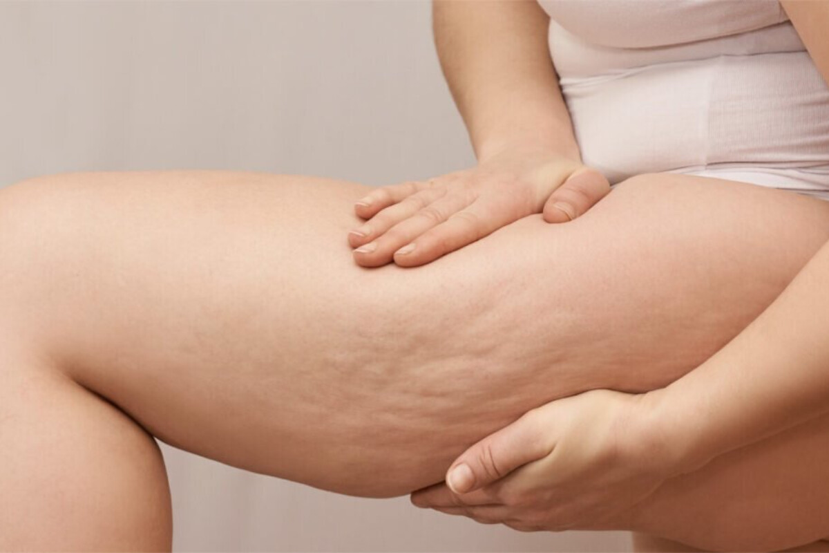 <p>Dermatoloq selülit haqqında məşhur mifləri dağıdır</p>