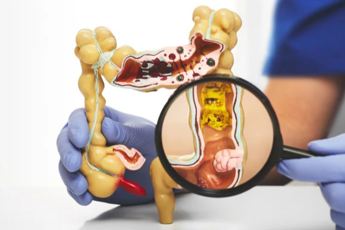 <p>Bağırsaq iltihabının genetik səbəbi aşkar edildi</p>